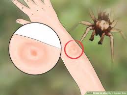 How To Identify A Spider Bite With Emr Approved Expert Advice