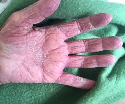Image result for scabies norvegica