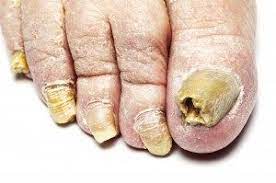 Simple And Safe Ways To Cure Ugly Toenails | Arch City Foot & Ankle