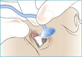Image result for Eye Irrigation