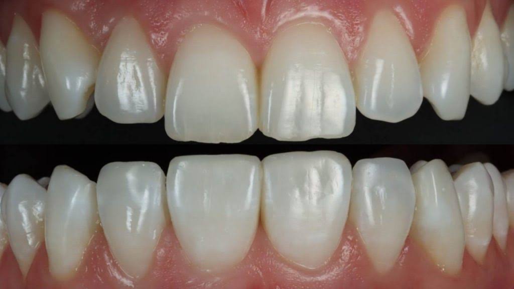 Tooth Coloured Fillings product image