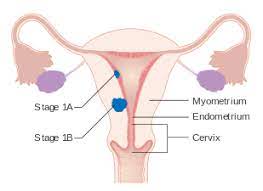 The stages of endometrial cancer are indicated using roman numerals ranging from i to iv, with the lowest stage indicating that the cancer hasn't grown beyond the uterus. Endometrial Cancer Wikipedia