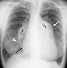Image result for Cor Pulmonale