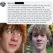 Our customers' results may seem shocking, but we have seen 𝟏𝟎𝟎.𝟎𝟎𝟎+  transformations like these. When people switch from low-quality products  and routines to Norse Organics, the skin gets immediate relief, and  overnight