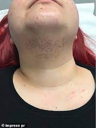 Thickened facial skin with coarse facial features. Woman With Pcos Who Started Growing Facial Hair In Her 20s Reveals Incredible Cure Daily Mail Online