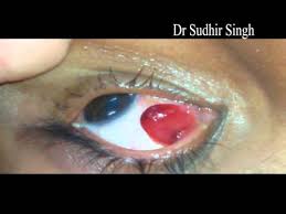 Check spelling or type a new query. Conjunctival Pyogenic Granuloma Excision Video Under Topical Anesthesia 122 Youtube