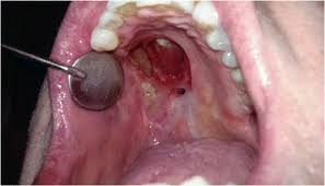 It occurs when too little blood flows to the tissue. Photobiomodulation Therapy Management Of Mucosal Necrosis Of The Oropharynx In Previously Treated Head And Neck Cancer Patients Springerlink