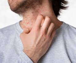 Image result for Vasculitis