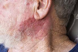 A year ago, my son noticed a pimple on my forehead. Bcc Skin Cancer On Chest Of Senior Male Stock Photo Image Of Senior Health 182140734