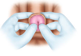 Image result for paraphimosis