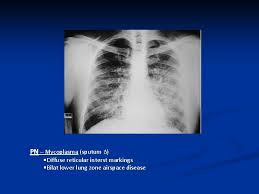 Alveolar Airspace Lung Disease Acute Chronic And Ground