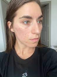 Though the red marks usually last from anything between four and twelve weeks the exact period depends on these factors. How Can I Fade My Acne Scars Fast Renee Rouleau