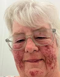 I have a question. My husband has scc