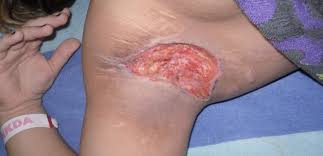 Hidradenitis Suppurativa Nedir Ve Nasil Tedavi Edilir