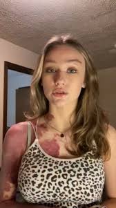 Woman Embraces Her Birthmark After Years of Enduring Bullying and Threats