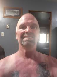 Anyone else been out this week. And got real bad sunburn?