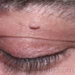 Maybe you would like to learn more about one of these? Skin Tags On Eyelids Weknoweyes Maple Grove Eye Doctors Pearle Vision