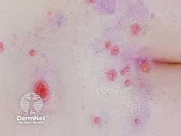 Image result for Pemphigus