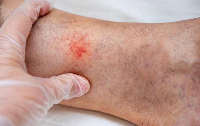 Stasis Dermatitis: How Vein Issues Cause Skin Changes | USA Vein Clinics