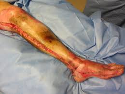 Escharotomy escharotomy involves full thickness incision of the circumferential burn down to the subcutaneous fat, in order to release constricting unyielding eschar. Emergency Care Of Moderate And Severe Thermal Burns In Adults Uptodate