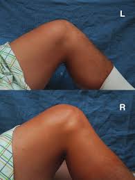 Image result for PCL Sulcus Test