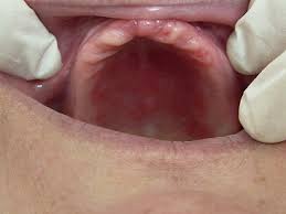 Image result for oral thrush symptoms roof of the mouth