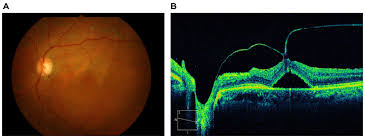There is a small risk of vision loss. Classification Of Posterior Vitreous Detachment Opth