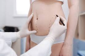 Di Addio Alle Maniglie Dell Amore Grazie Alla Liposuzione Sceb