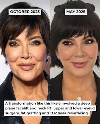 Kris Kardashian Operation