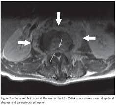 Image result for Spinal Epidural Abscess