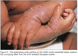 Image result for scabies human children