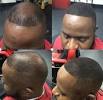 Receding Hair Loss Black Men