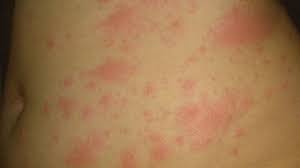И симптоматику легко спутать с другими. Koronavirus Kovidnye Palcy I Syp Kak Simptomy Covid 19 Bbc News Russkaya Sluzhba