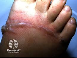 Image result for Rhus Dermatitis