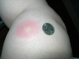 Image result for flea bite