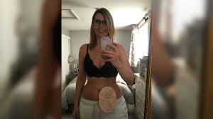 Crohn S Disease Woman Abused For Accessible Toilet Use Bbc News