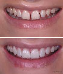 This guide gives a great overview of top dental insurance. Aesthetic Dentistry Advance