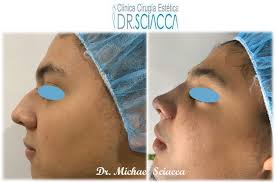 RINOPLASTIA‼ Para más información llámanos 👨‍⚕️Dr. Michael Sciacca 📞  Consultorio 2261-9000 📲WhatsApp 8589-9000 Aprovecha nuestros excelentes  sistemas de financiamiento 100% Será un gusto servirles.
