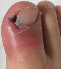 Image result for Paronychia feet