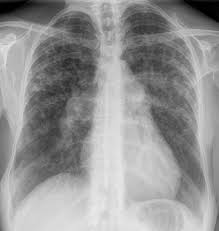 Pneumologie Unsere Krankheitsbilder Im Rontgenbild