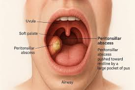Image result for Peritonsillar Abscess