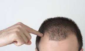 علاج تساقط الشعر للرجال وقاية Hair Replacement Hair Fixing Hair Replacement Systems