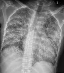 Image result for Transfusion Associated Circulatory Overload