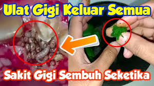 Sakit gigi merupakan salah satu penyakit yang cukup menyiksa. Sakit Gigi Sembuh Seketika Sampai Ulat Gigi Keluar Semua Youtube