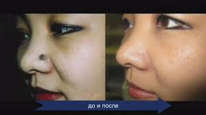 Artinya, anda sebenarnya tidak perlu menghilangkan tahi lalat kecuali itu memang dianggap mengganggu. Cara Menghilangkan Tahi Lalat Di Hidung Belajar