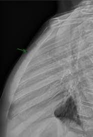 Image result for Sternal Fracture