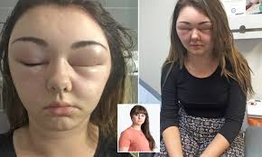However the hair that triggered the symptoms did not contain ppd. Sales Coordinator Blinded After Allergic Reaction To Hair Dye Daily Mail Online