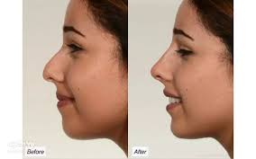 فیلر بینی چیست؟ چگونه با تزریق ژل به بینی فرم بینی اصلاح می‌شود؟