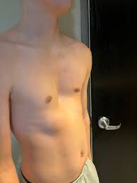 Image result for Pectus Excavatum