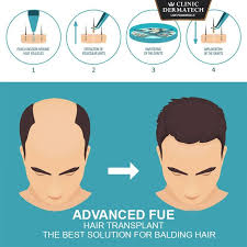 Pin On Hair Loss